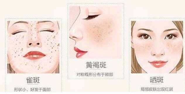 美容祛斑需要多少钱？全面解析祛斑费用因素