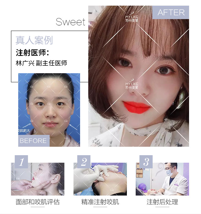 瘦脸针团购，美丽新风尚