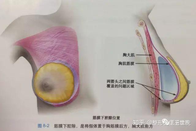 假体隆胸手感，真实与自然的融合