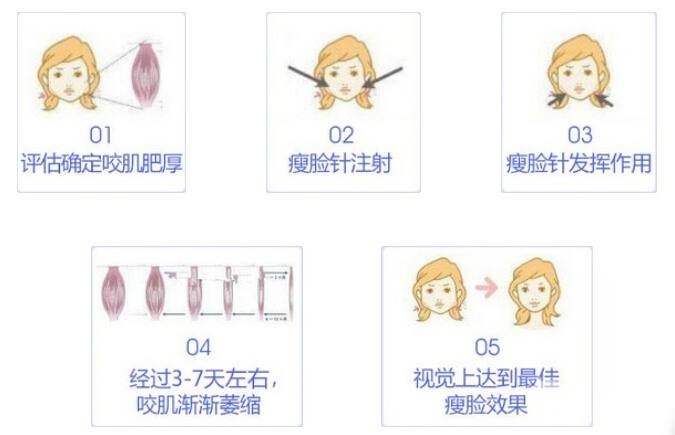 瘦脸针价格多少——深入了解瘦脸针的价格因素