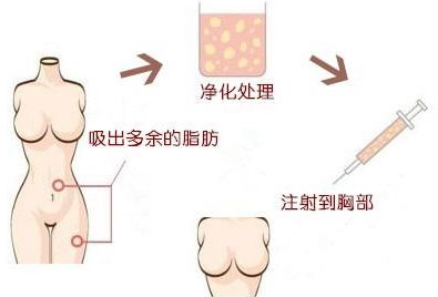 吸脂手术费用