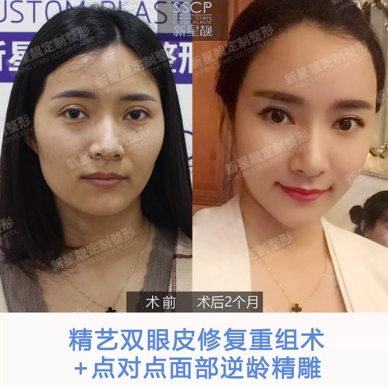 自体脂肪面部填充费用详解