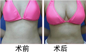 硅胶隆胸需要多少钱，全面解析隆胸费用及其相关因素